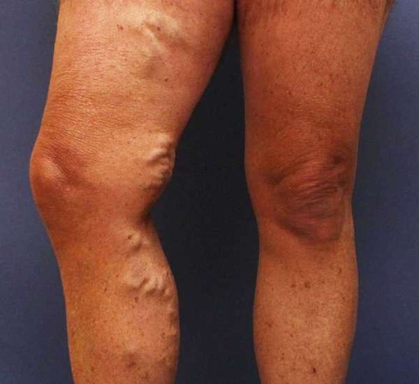 Varicose Veins