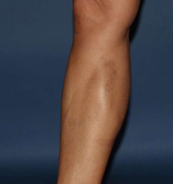 Varicose Veins