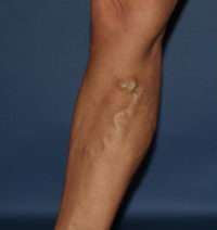 Varicose Veins
