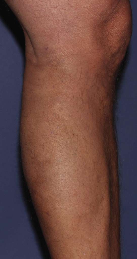 Varicose Veins