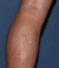 Varicose Veins