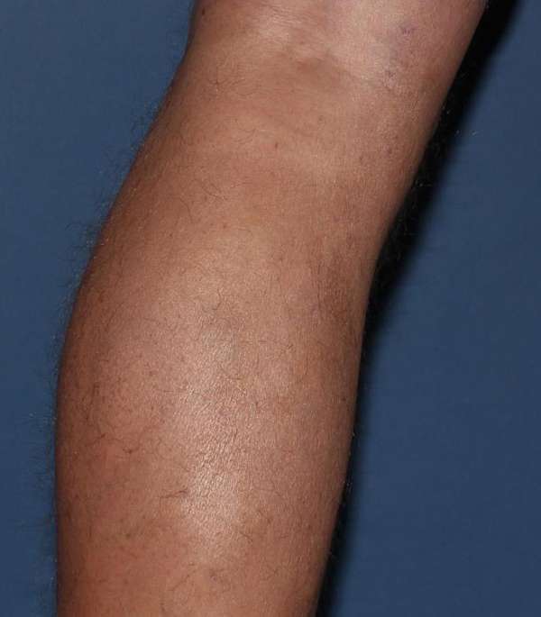 Varicose Veins