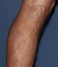 Varicose Veins