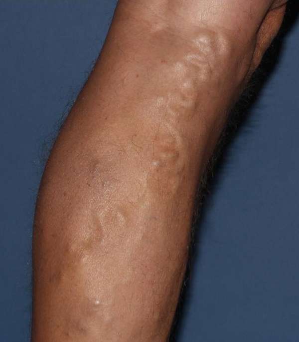 Varicose Veins