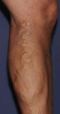 Varicose Veins