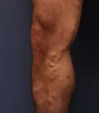 Varicose Veins