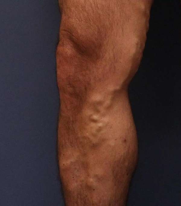 Varicose Veins