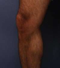 Varicose Veins