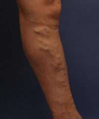 Varicose Veins