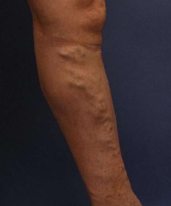 Varicose Veins