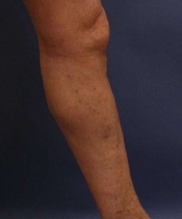 Varicose Veins