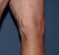 Varicose Veins