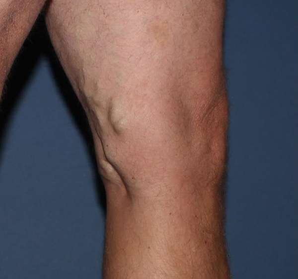 Varicose Veins