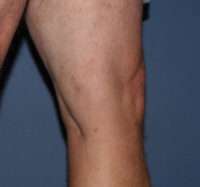 Varicose Veins