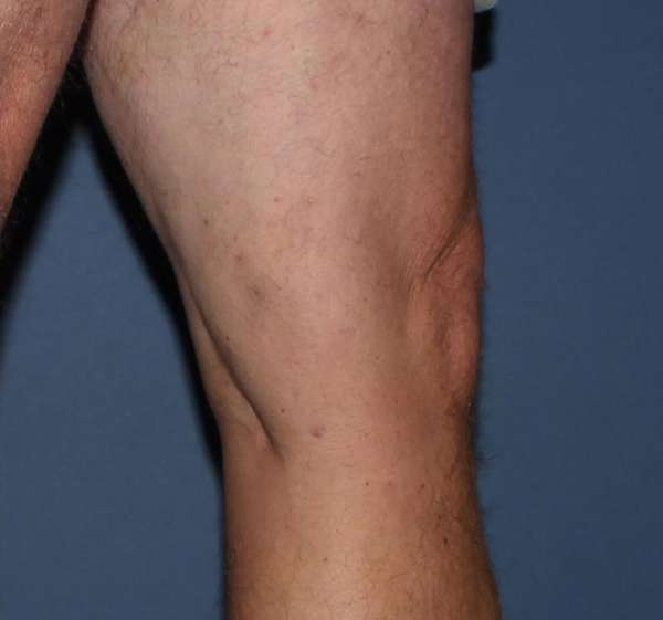 Varicose Veins