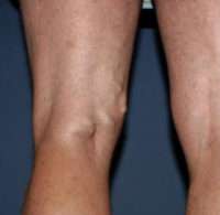 Varicose Veins