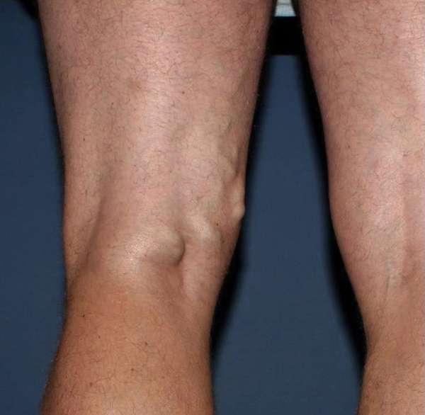 Varicose Veins