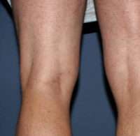 Varicose Veins