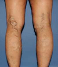 Varicose Veins