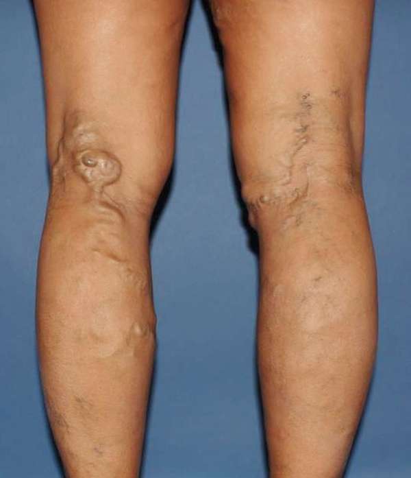 Varicose Veins