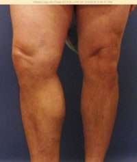 Varicose Veins