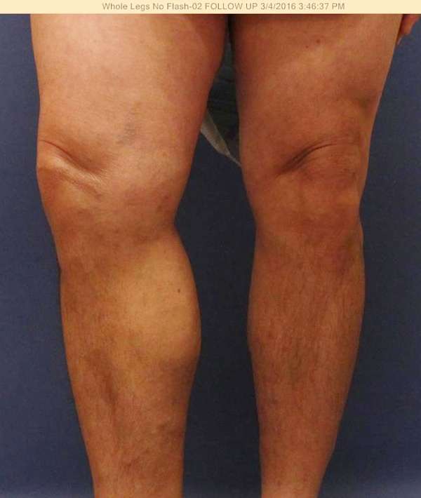 Varicose Veins