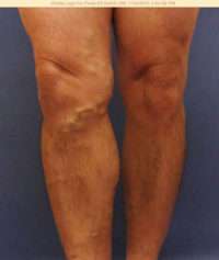 Varicose Veins
