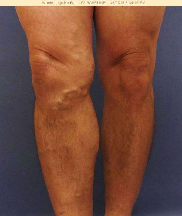 Varicose Veins