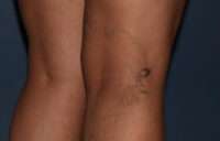 Varicose Veins