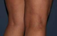 Varicose Veins