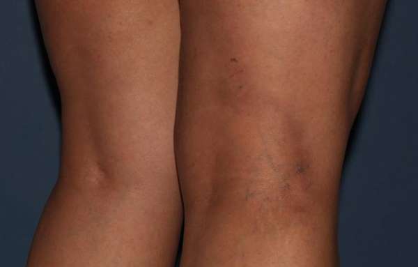 Varicose Veins