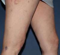 Spider Veins