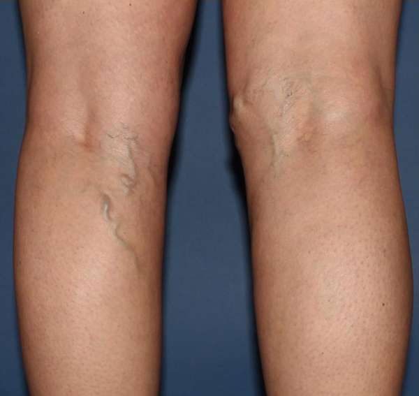 Spider Veins