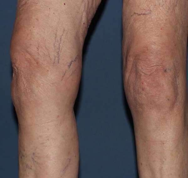 Spider Veins